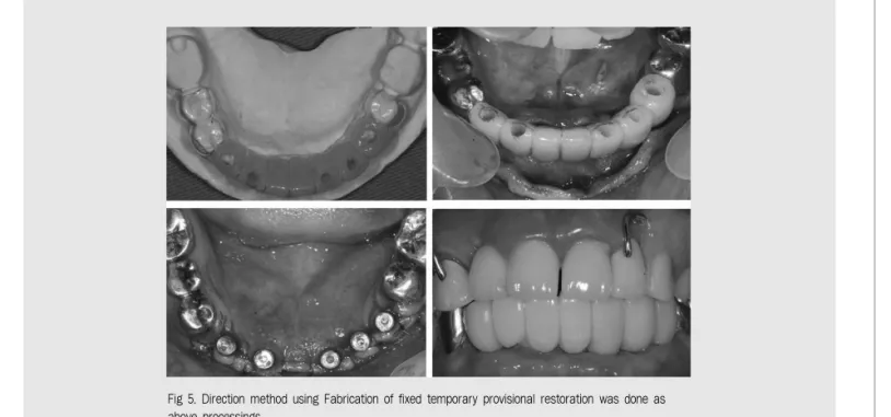 Fig 5. Direction method using Fabrication of fixed temporary provisional restoration was done as above processings.