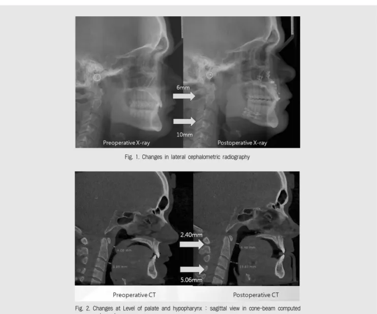 Fig. 1. Changes in lateral cephalometric radiography