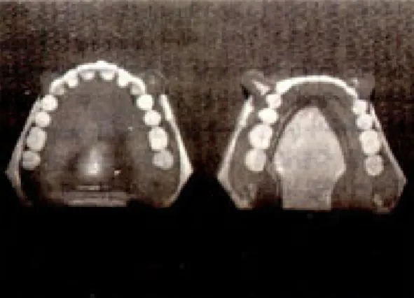 Fig.  5.  The  tooth  contacts  recorded  by  the articulating ribbon before processing.