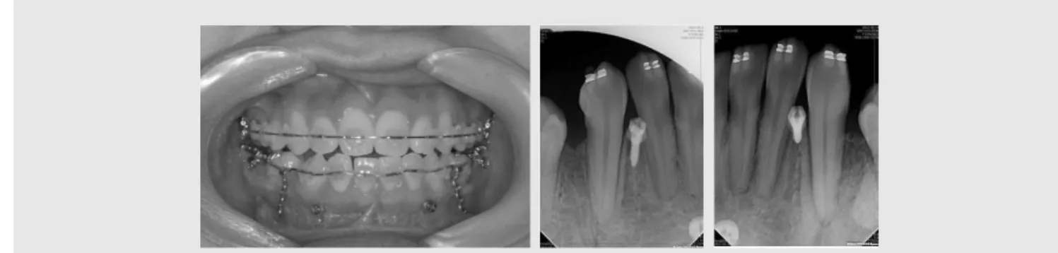 Fig.  1.  Mini-implants.  Two  mini-implants  were  placed  between  lateral  incisors  and  canines  to  protract  the posterior segments.
