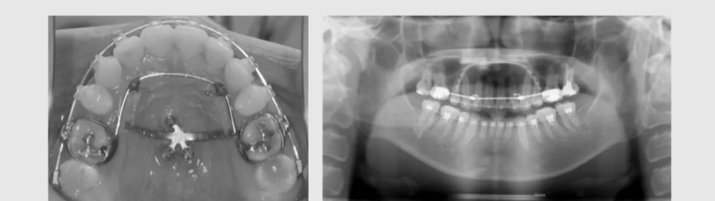 Fig. 3 Palatal plate.  The maxillary molars are being retracted distally and the resultant spaces are shown at the mesial of the first molars