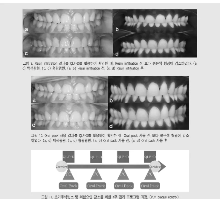 그림 9. Resin infiltration 결과를 QLF-D를 활용하여 확인한 예. Resin infiltration 전 보다 붉은색 형광이 감소하였다