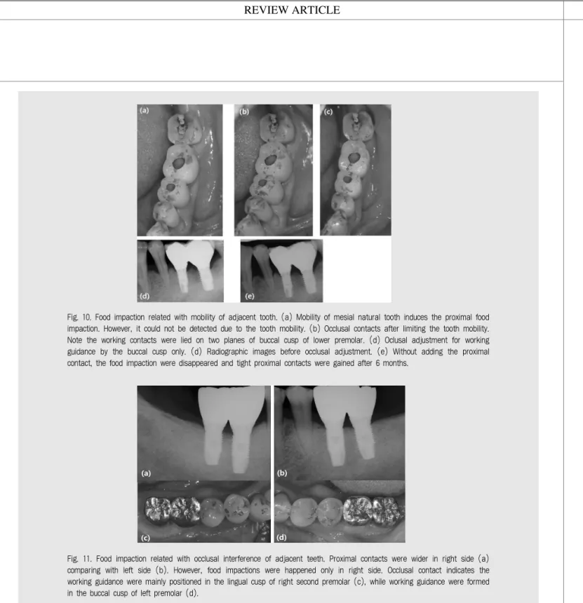 Fig. 10. Food impaction related with mobility of adjacent tooth. (a) Mobility of mesial natural tooth induces the proximal food impaction