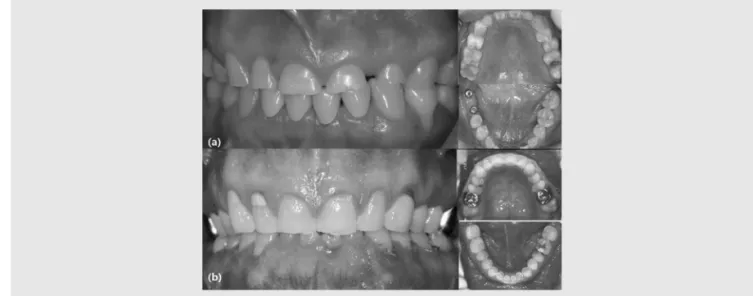 Fig. 12. Anterior teeth wear from centric occlusion (CO) - maximum intercuspation (MI) discrepancy