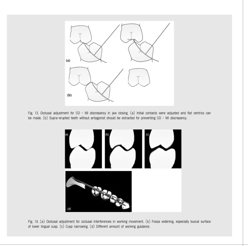 Fig. 13. Occlusal adjustment for CO - MI discrepancy in jaw closing. (a) Initial contacts were adjusted and flat centrics can be made