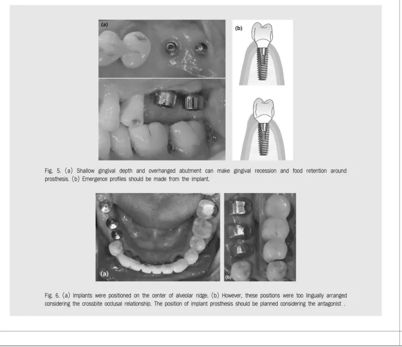 Fig. 6. (a) Implants were positioned on the center of alveolar ridge. (b) However, these positions were too lingually arranged considering the crossbite occlusal relationship