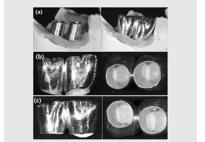 Fig. 7. (a) CAD-CAM customized abutments and prosthesis. (b) Narrow interdental embrasure induces gingival pressure and gingival recession