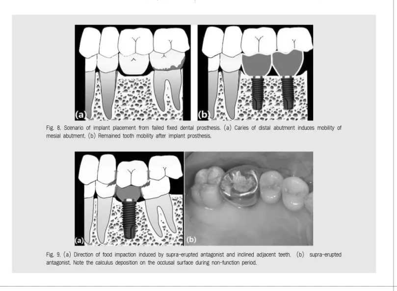 Fig. 8. Scenario of implant placement from failed fixed dental prosthesis. (a) Caries of distal abutment induces mobility of mesial abutment