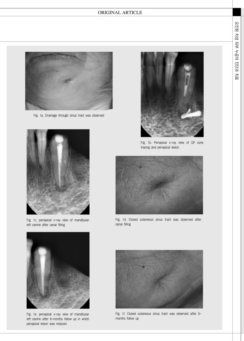Fig. 1a. Drainage through sinus tract was observed 
