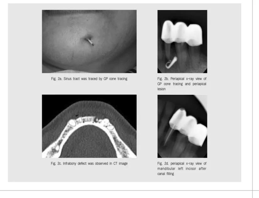 Fig. 2a. Sinus tract was traced by GP cone tracing Fig. 2b. Periapical x-ray view of GP  cone  tracing  and  periapical lesion