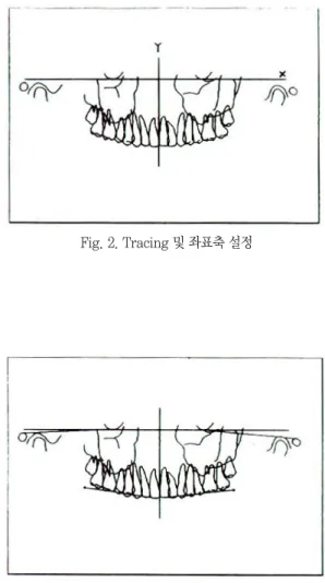 Fig. 4. 17M Line의 모식도 상악중절치의 중점과 상악 제2 대구치의 근심협측교두정을 연결한 평면으로 하였다.