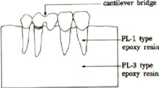 Fig. 3. Cantilever bridge with rest-extension pontic 