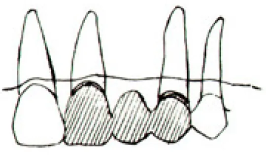 Table 1. Models according to crown/root ratio an pontic type