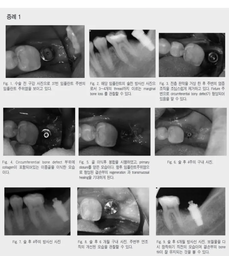 Fig. 1. 수술 전 구강 사진으로 37번 임플란트 주변의 임플란트 주위염을 보이고 있다.  Fig. 2. 해당 임플란트의 술전 방사선 사진으로서 3~4개의 thread까지 이르는 marginal bone loss 를 관찰할 수 있다
