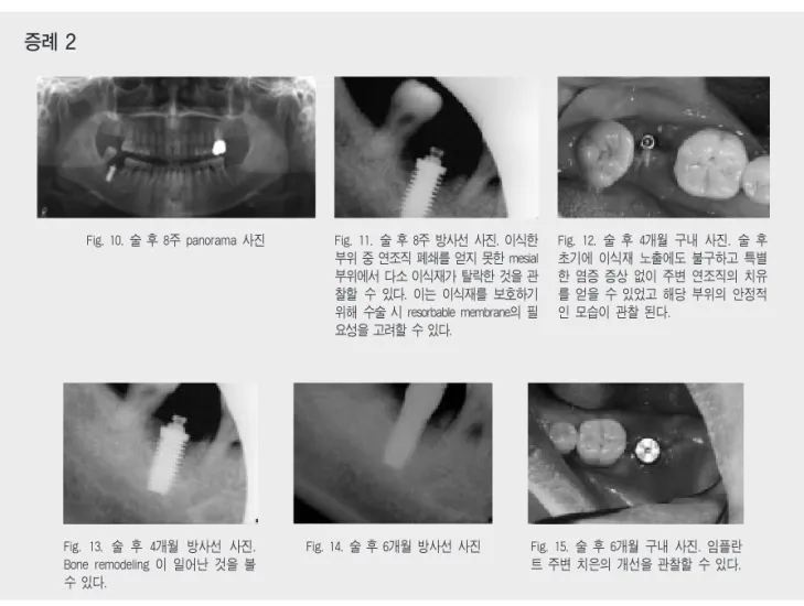 Fig. 10. 술 후 8주 panorama 사진 Fig. 11. 술 후 8주 방사선 사진. 이식한 부위 중 연조직 폐쇄를 얻지 못한 mesial 부위에서 다소 이식재가 탈락한 것을 관 찰할 수 있다