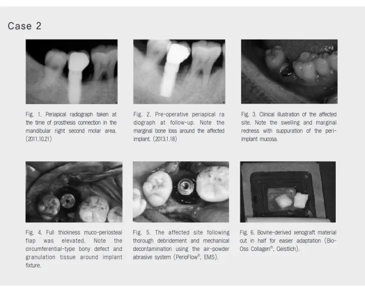 Fig.  1.  Periapical  radiograph  taken  at the time of prosthesis connection in the mandibular  right  second  molar  area.