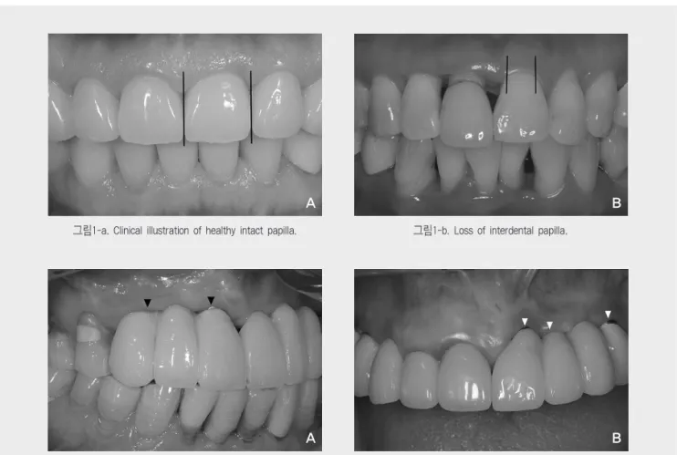 그림 2-a,b Unesthetic outcome, attributed to improper mesiodistal positioning of implants.