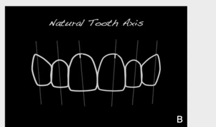 그림 3-a.  The  unnatural  location  of  gingival  zenith  and direction of tooth axis due to fixture position