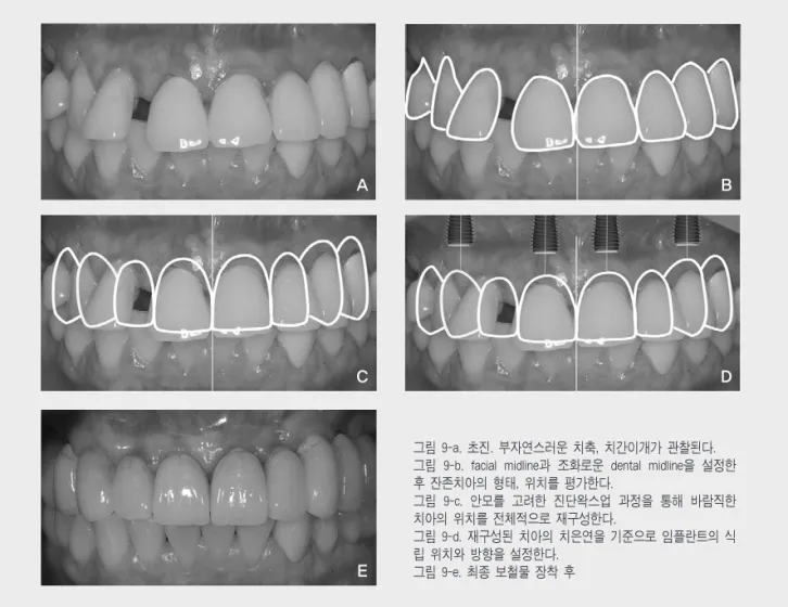 그림 9-a. 초진. 부자연스러운 치축, 치간이개가 관찰된다.