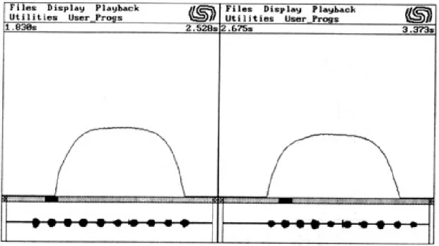 Fig. 6-a. A view of the comparison of energy level; no differences before and after prosthesis inserted conditions.(Informant C, sound : /na(나)/)
