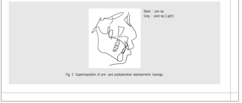 Fig. 2. Superimposition of pre- and postoperative cephalometric tracings.