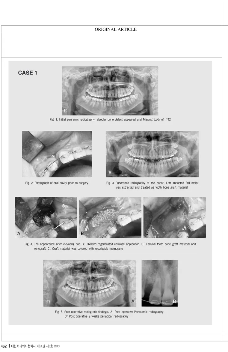 Fig. 1. Initial panramic radiography. alveolar bone defect appeared and Missing tooth of #12