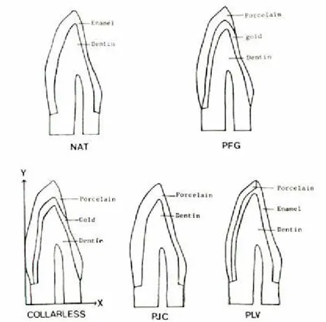 Fig. 1. Cross-sectional view of anterior esthetic restoration and abutment with varous design.