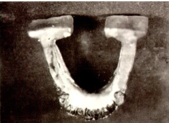 Fig. 4. Removable partial denture frameworks with three different types of the major connector (a) lingual bar