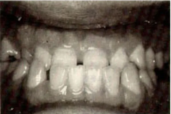 Fig. 2. Anterior view of experimental group(Group 2)