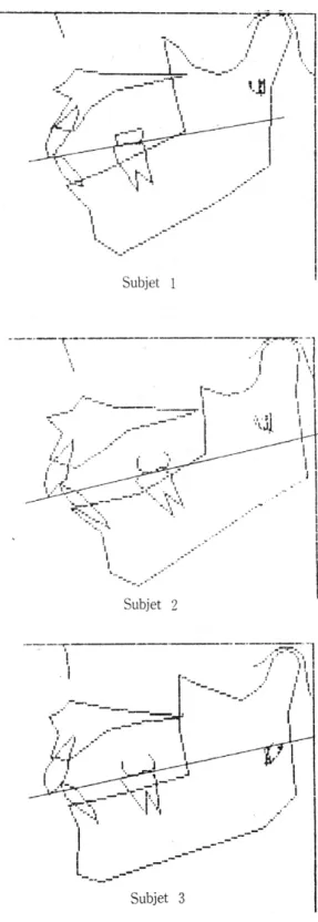 Table 4. Moving distances of a minimum moving point at the habitual opening and closing mandibular movements