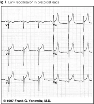 Fig 2.  Notch  of  downsloping  limb  of  the  QRS  complex  in  the  early reploarization