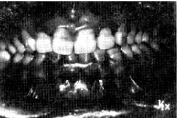 Table  1.  Distribution  of  Dicor  crowns  which  were observed.