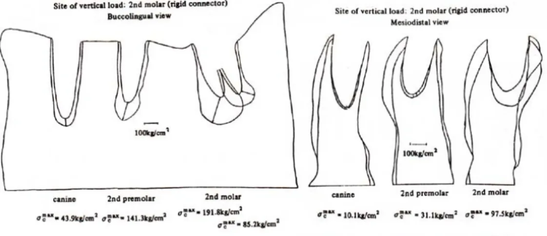 Fig. 5 : Stress distribution of application loade to the 2nd molar of rigid connector