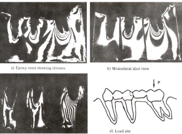 Fig. 7 : Stress distribution of application load to the 2nd molar of nonrigid connector