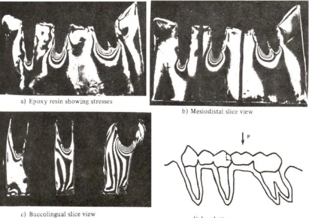 Fig. 11 : Stress distribution of application load to the 1st molar of nonrigid connector