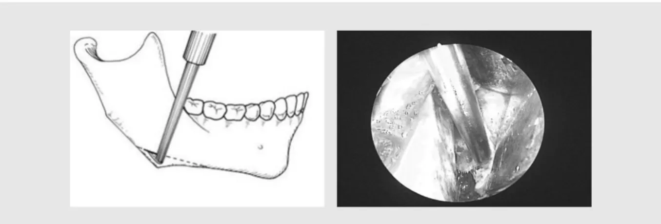 Fig. 1. Mandibular angle shaving
