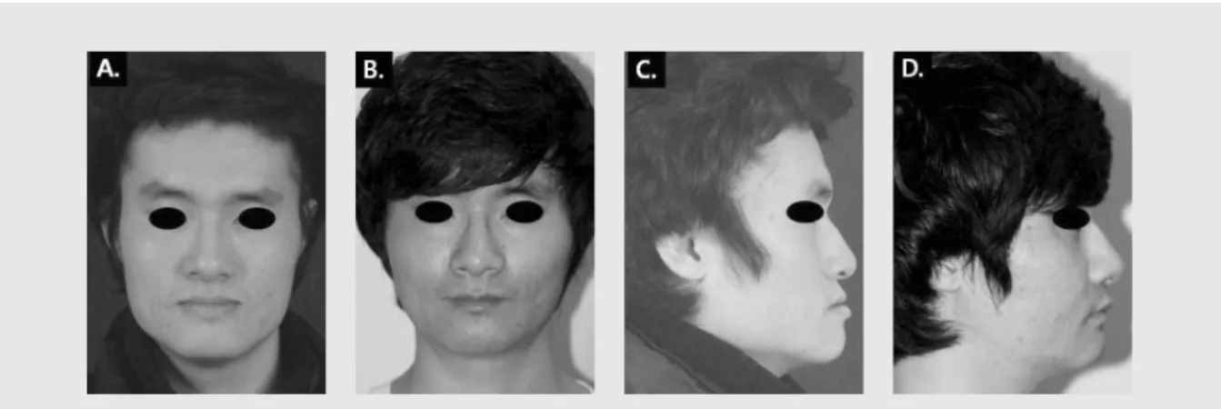 Fig. 4. Photographs of a man patient (A) Preoperative frontal view. (B) Postoperative frontal view