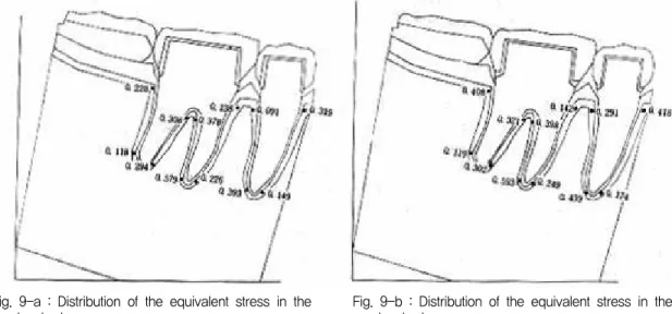 Fig. 8-b : Vertical vector of the stress induced in the alveolar bone.
