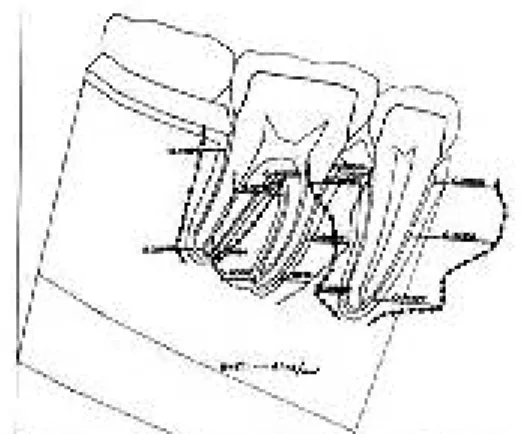 Fig. 9-d : Distribution of the equivalent stress in the alveolar bone(1/2 length).