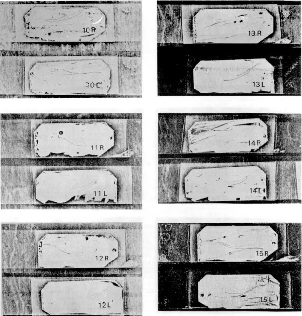 Fig. 1-2 : Pantographic recordings of right and left condyles of the subjects representing protrusive and lateral border movements at each condyle