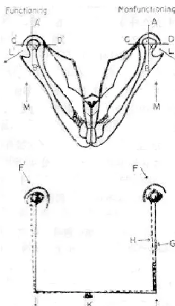 Fig. 13 : Unilateral loss of posterior teeth, wit resultant consequences.