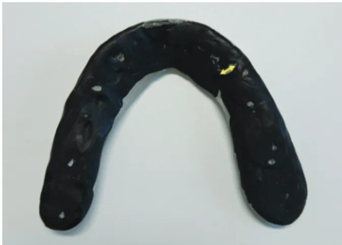 Fig. 1.  Occlusal facets present on the appliance. After 2 weeks, the surface texture was assessed, and the lengths of the facets formed by the  mandibular canines were measured.