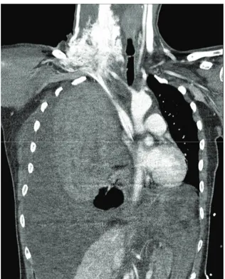 Fig. 2.  Intraoperative chest radiograph (PA view, prone position) showing  massive hemothorax in the right lung field.