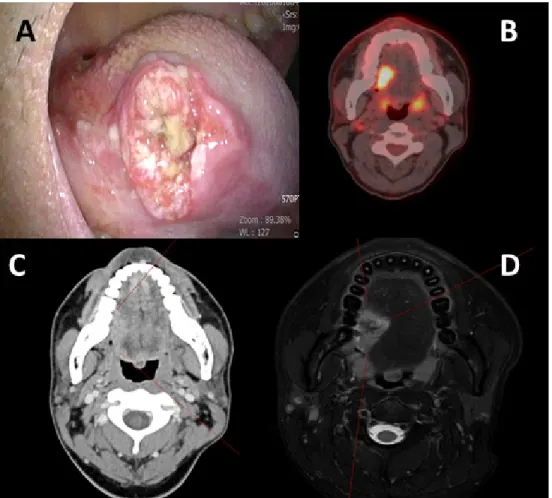 Fig. 1.  Preoperative images of patient with hemophilia A. (A) Image of patient’s tongue lesion taken during first clinical visit
