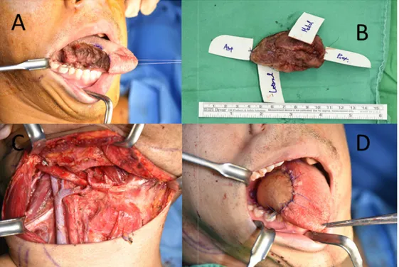 Fig. 2.  Preoperative images of patient with hemophilia A. (A) Intraoperative image after right partial glossectomy
