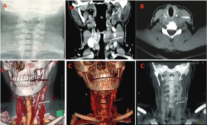 Fig. 1. A: X-ray showed a long, thin, smooth, and impinged foreign body (FB) at the C5-C6 level, lying lateral to the esophagus