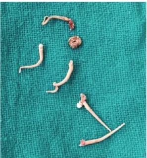 Fig. 6. A photograph shows gutta percha retrieved from the periodontal ligament space in relation to 13.