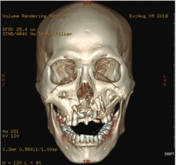 Fig. 1.  Pre-operative 3-dimensional reconstructed computed tomography image of the patient