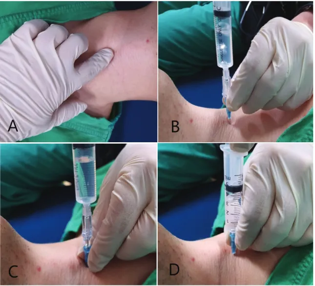 Fig. 2. Transtracheal injection procedure. A: Find the cricothyroid membrane between the thyroid cartilage and the cricoid cartilage