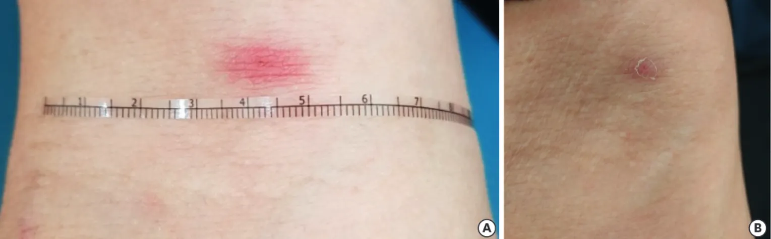 Figure 1. Photographs of Case 1. An erythematous patch measuring 8 × 16 mm in diameter on the right antecubital fossa is noticed, accompanied with a central  circle of 1 mm in diameter (A)